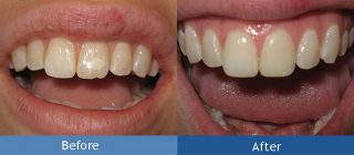 tooth restoration billings mt