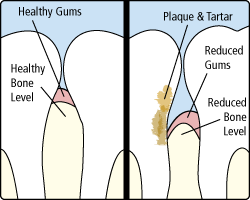 periodontitis, gum disease treatment billings mt