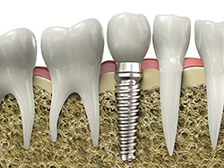 dental implants billings mt