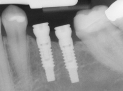 dental implants billings mt